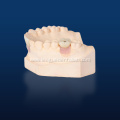Implant Crown and Bridge